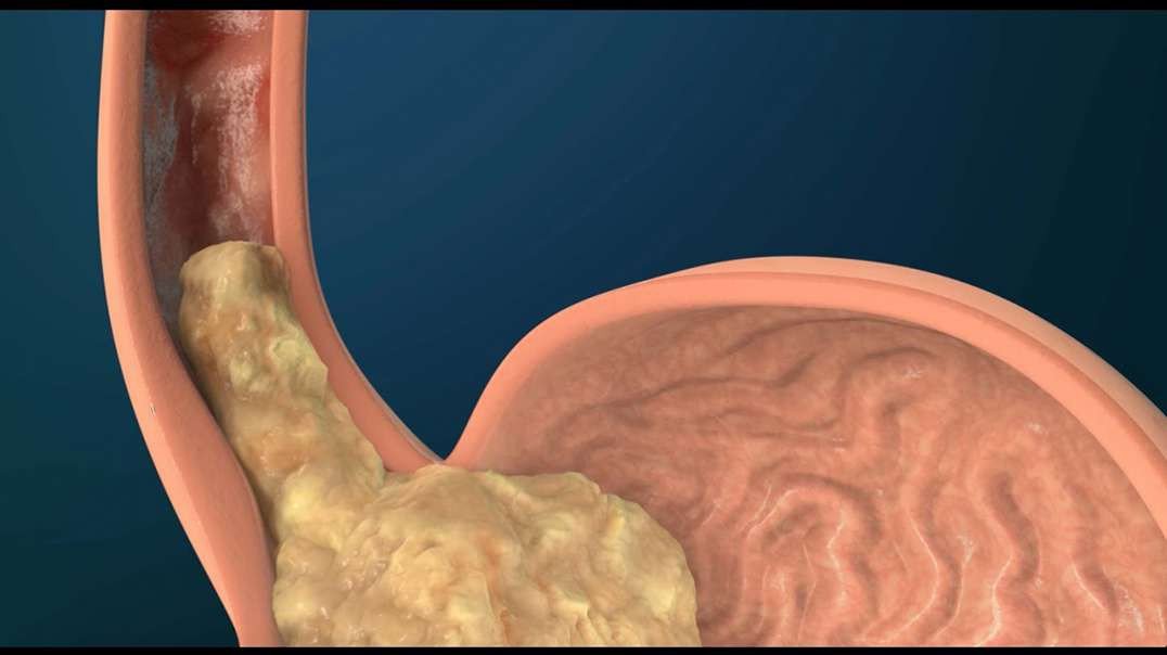 What Causes Gastroesophageal Reflux Disease (GERD)